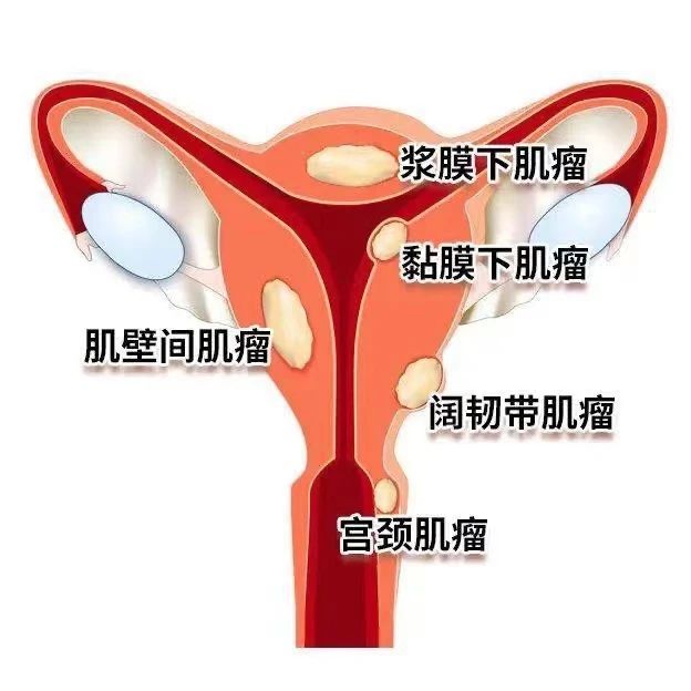 子宫肌瘤位置.jpg