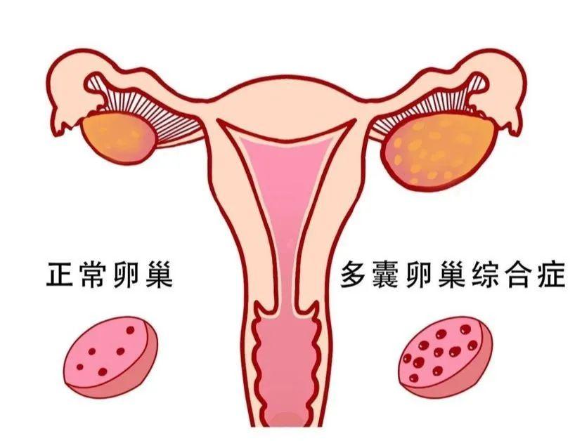 治療多囊性卵巢癥候群：調整激素水平的關鍵