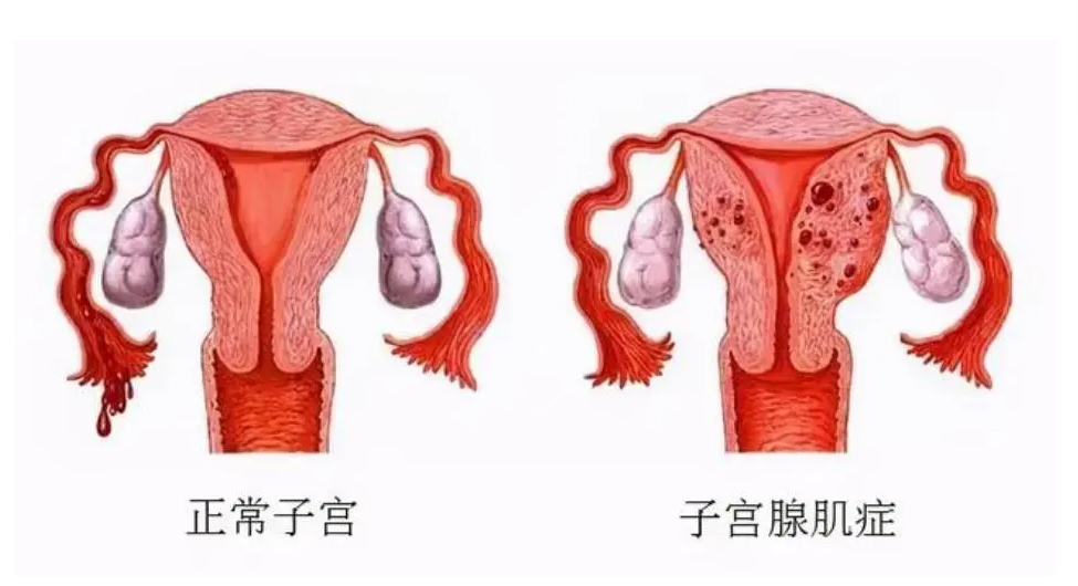 子宫腺肌症.png